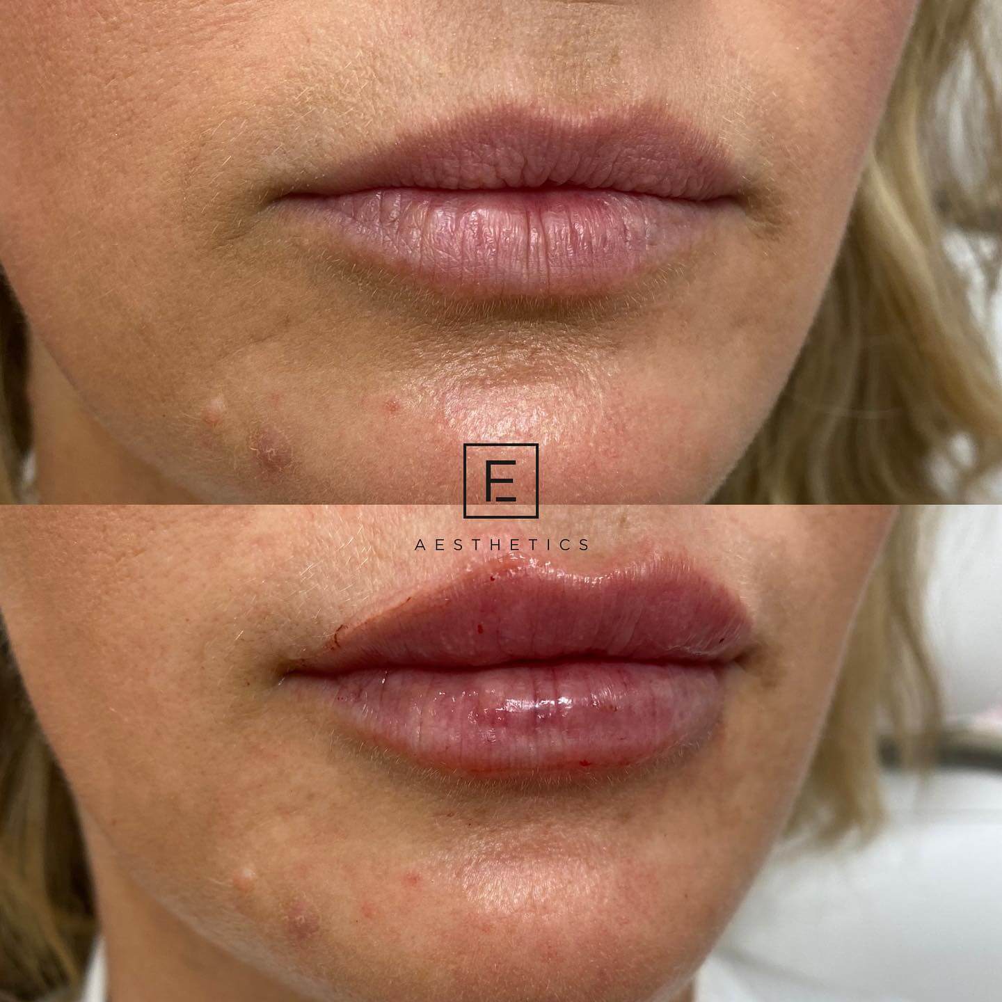 Before & After Fillers