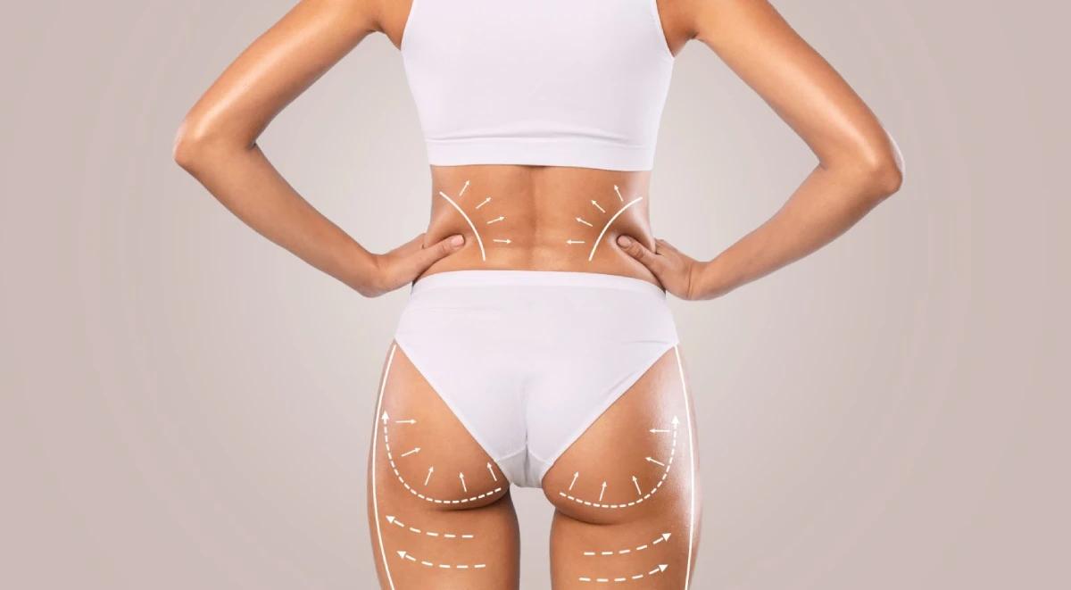 What is Brazilian Butts Lift BBL Surgery in Mesa, AZ | Emily Frost Aesthetics