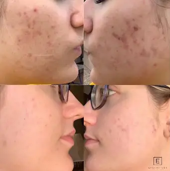 Lady Acne Before and After | Emily Frost Aesthetics