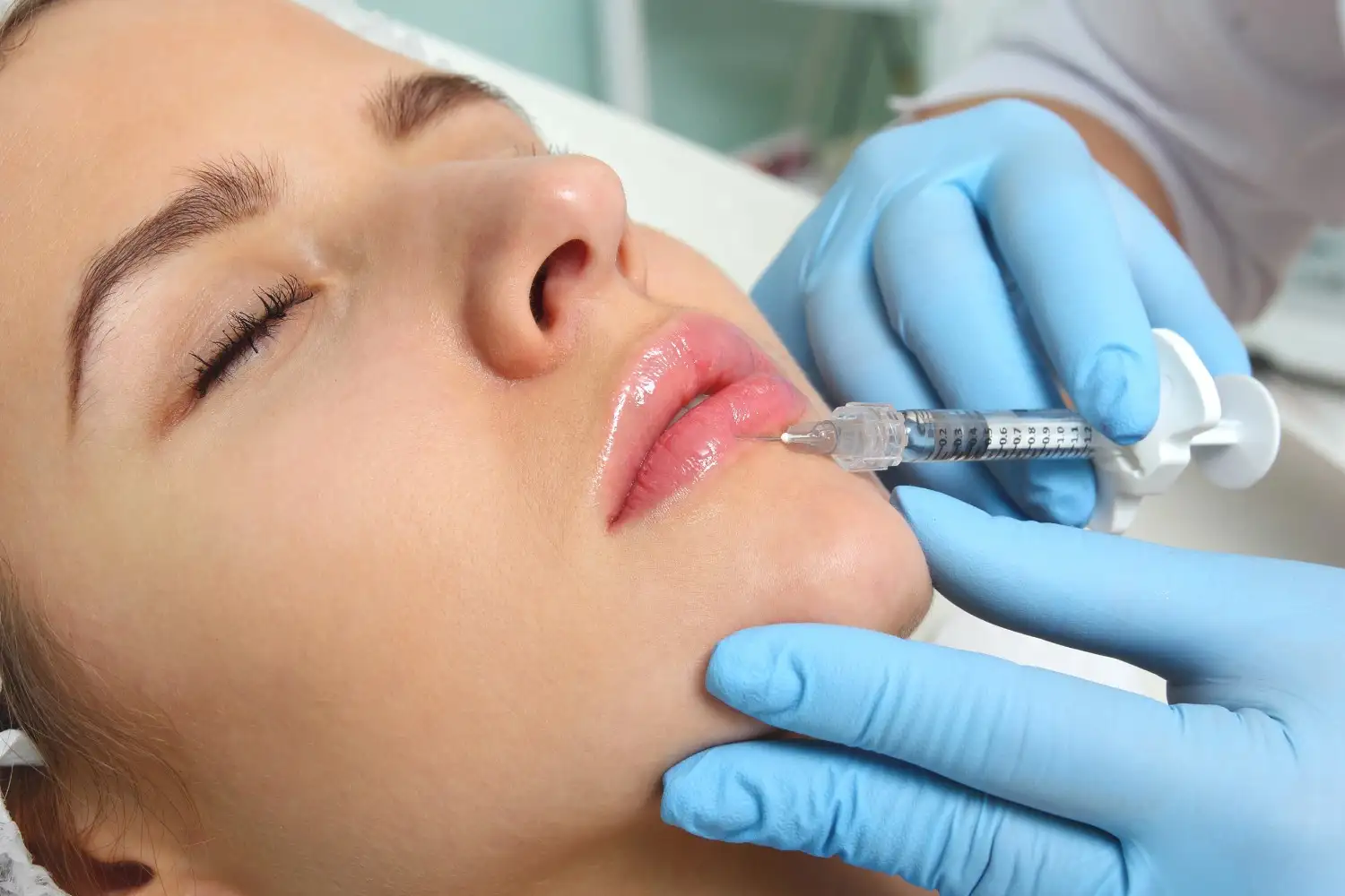 How to Avoid Duck Lips With Lip Fillers