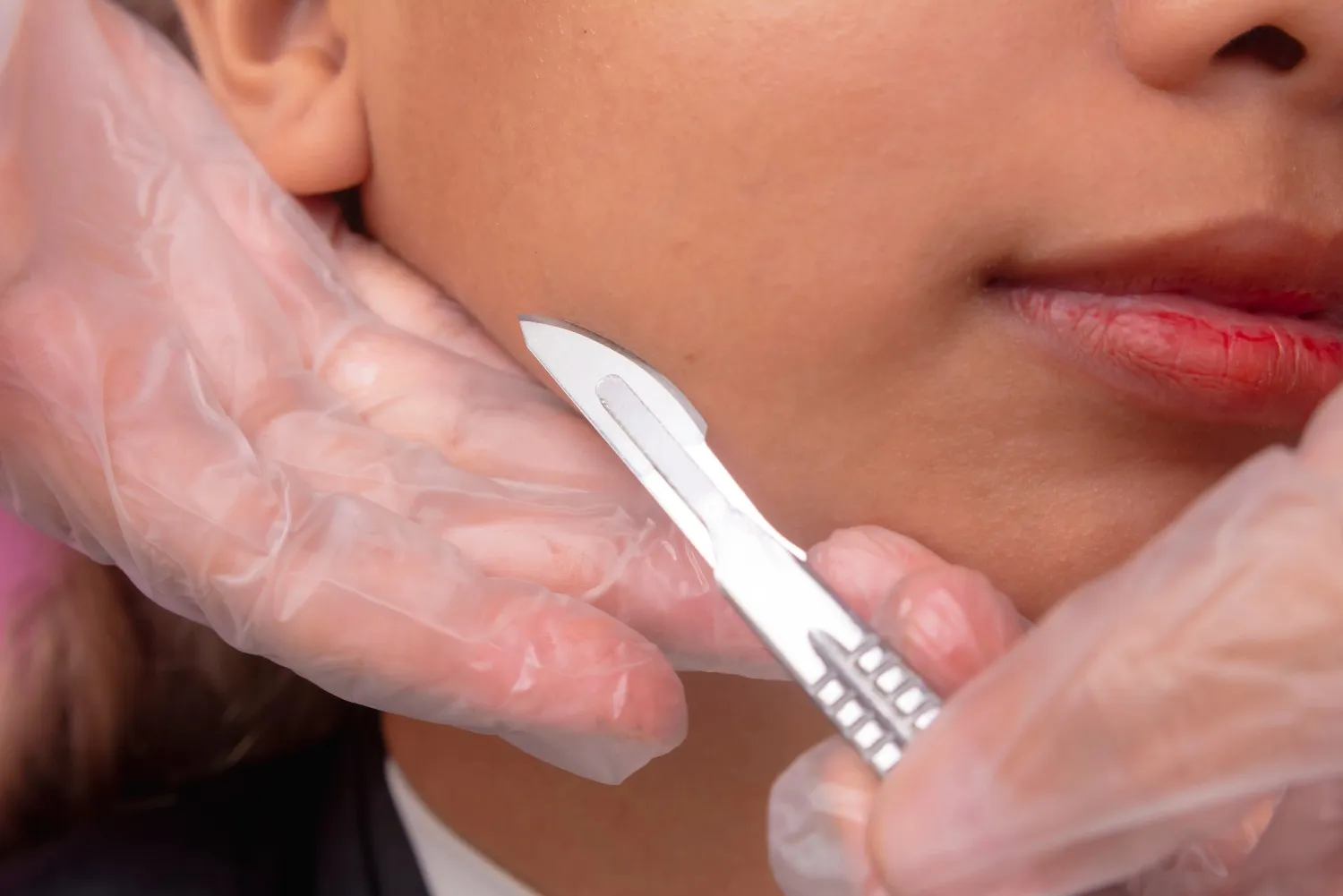 Does Dermaplaning Cause Hair to Grow Back Thicker?