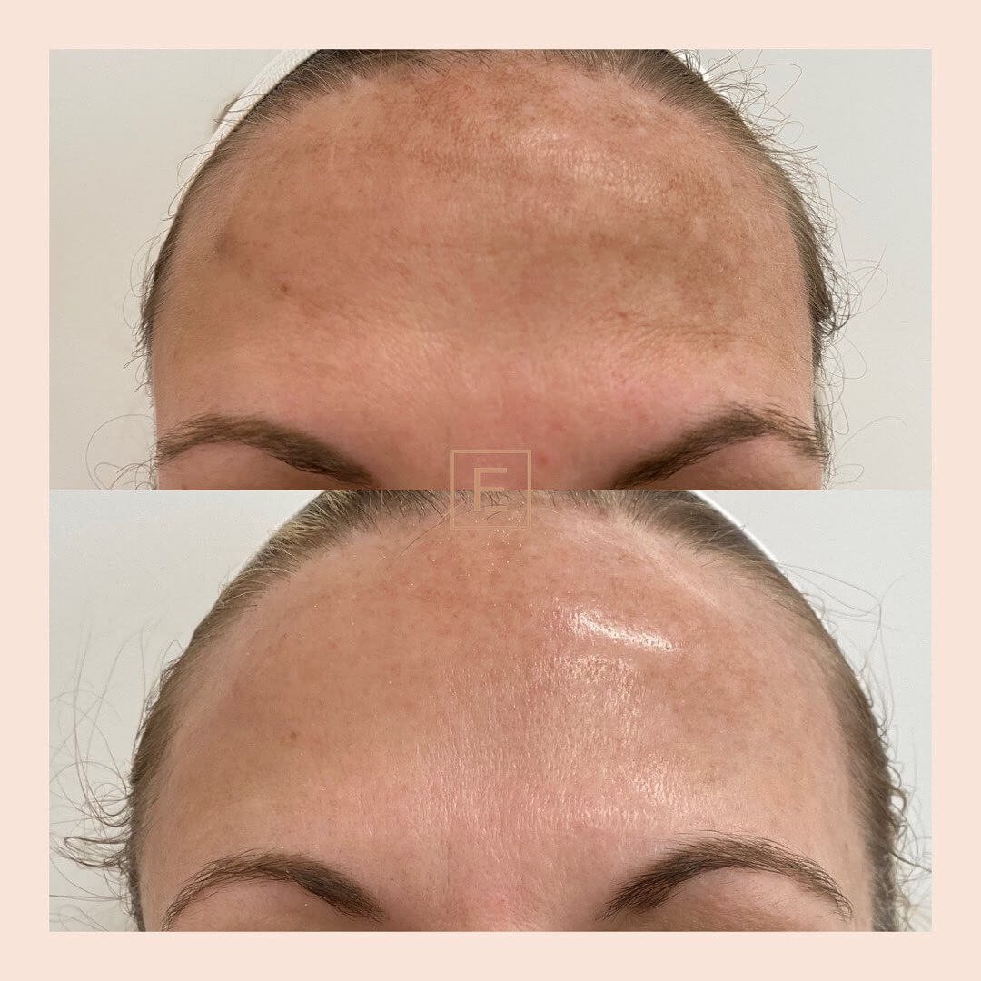 Before & After Image Botox