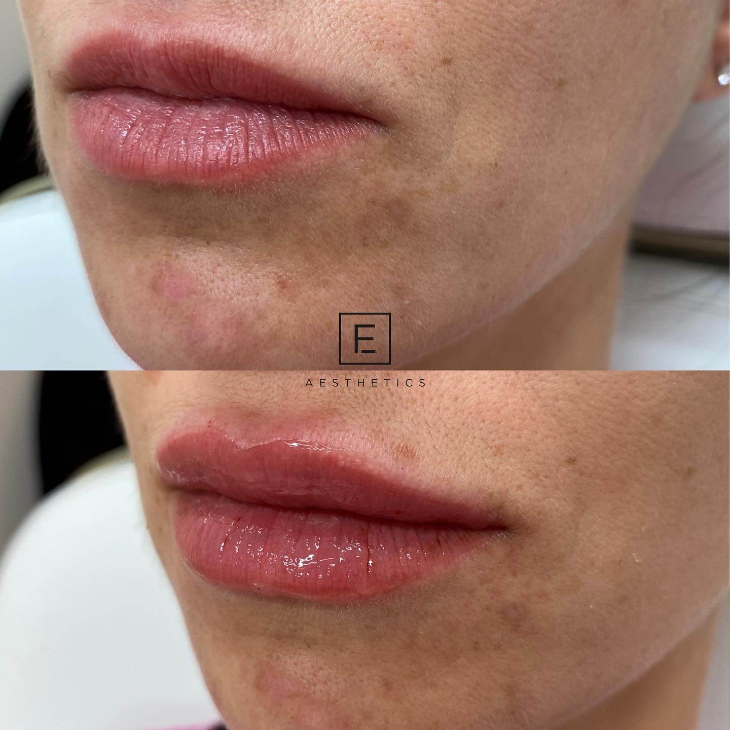 Before & After Fillers