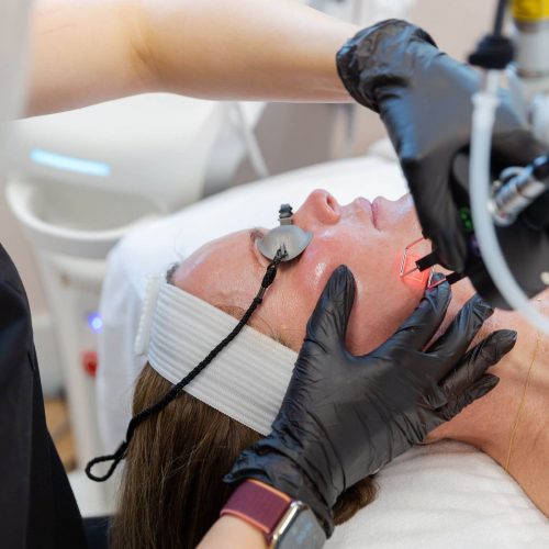 CoolPeel Laser – Mesa, AZ | Aesthetic Med Spa | Emily Frost Aesthetics Cool Peel Laser